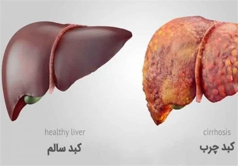 خرما و کبد چرب + مزایا و معایب