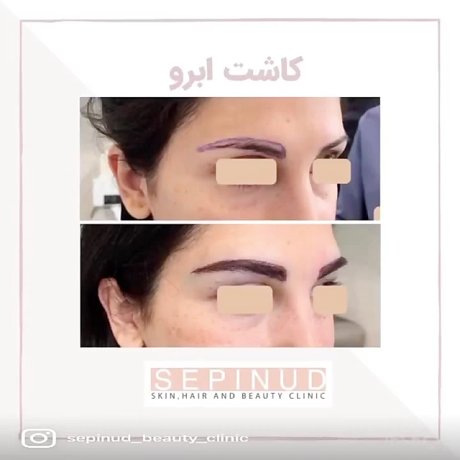  همه چیز درباره کاشت ابرو به روش fit از هزینه و مراحل تا مزایا و مراقبت های بعد از عمل