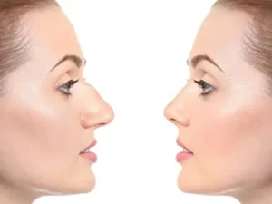 آیا عمل بینی زیر ۱۸ سال خطرناک است؟