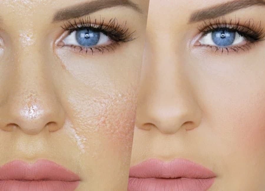 چه هورمونی باعث چرب شدن پوست میشود |درمان چربی صورت و جوش