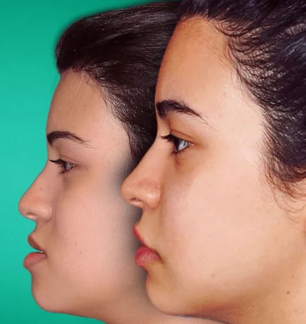 جراحی فک چند ساعت طول میکشد؟