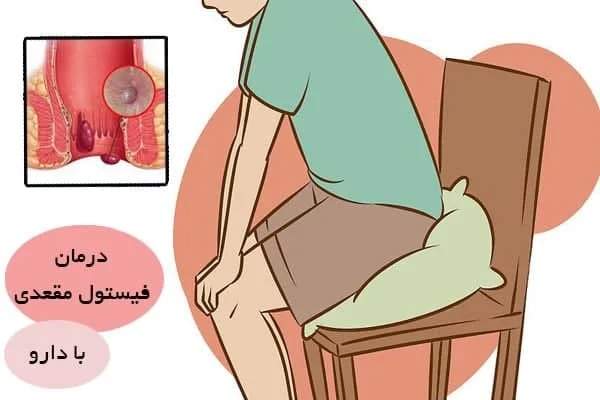 درمان شقاق مقعدی در طب سنتی دکتر خیراندیش