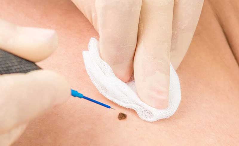 Types of moles and their removal methods