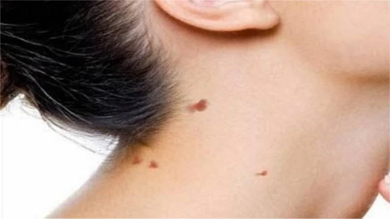 جلوگیری از عود زگیل تناسلی