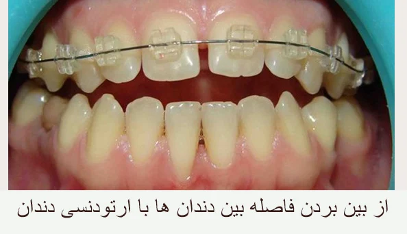 فاصله بین دندان ها بعد از ارتودنسی