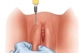 تزریق چربی به واژن