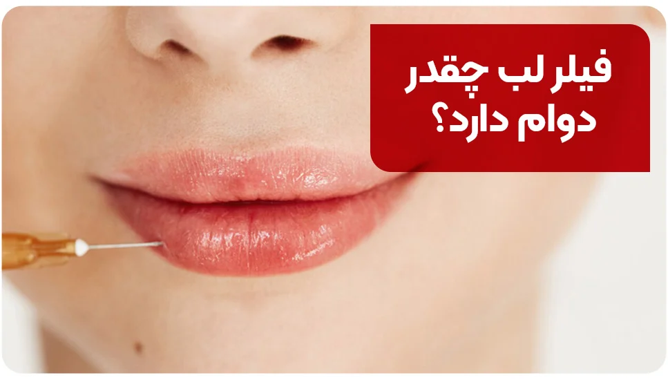 ماندگاری فیلر لب چقدر است؟ فیلر لب چقدر دوام دارد؟