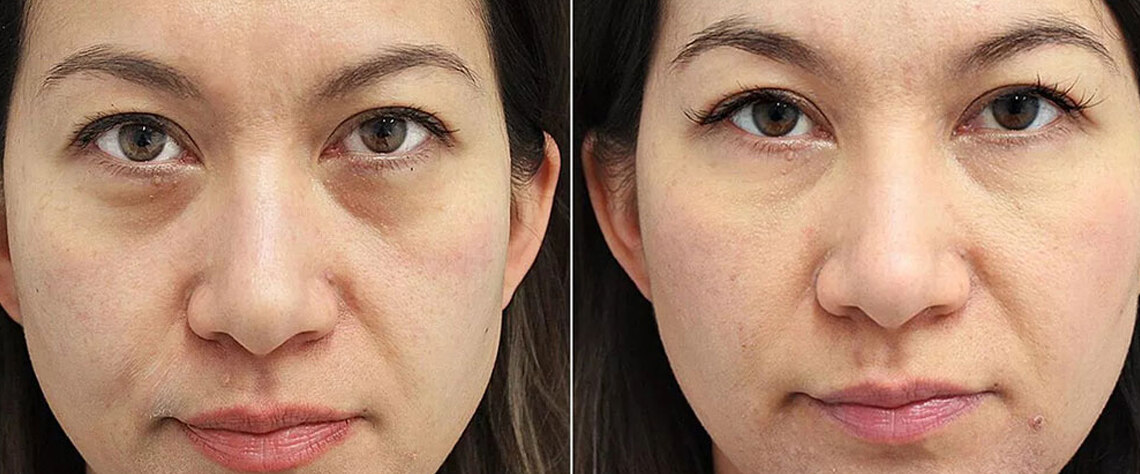 استرس |پوست