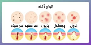 کاربرد اسید سالیسیلیک و بنزوئیل پراکسید برای درمان آکنه
