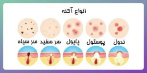 کاربرد اسید سالیسیلیک و بنزوئیل پراکسید برای درمان آکنه کاربرد اسید سالیسیلیک و بنزوئیل پراکسید برای درمان آکنه