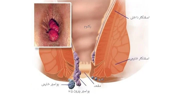 درمان خانگی بواسیر بیرون زده درمان خانگی بواسیر بیرون زده